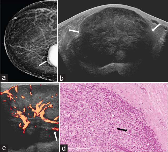 50-year-old female with history of uterine leiomyosarcoma, status post hysterectomy presented for evaluation of a palpable abnormality in the right breast. (a) CC view of the right breast demonstrates a partially visualized dense mass in the inner breast, posterior depth (arrow). (b) Gray-scale and (c) power Doppler images show a large circumscribed hypoechoic mass with internal vascularity (arrows) corresponding to mammographic abnormality. (d) Photomicrograph of the surgical specimen (H and E stain, 20×) demonstrates markedly enlarged cells with marked cytologic atypia and abundant cytoplasm (arrow). Increased mitotic activity and the presence of atypical mitotic figures are also identified in other areas.