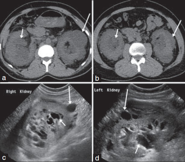 38-year-old male presented with bilateral flank pain and was later diagnosed with bilateral renal lymphangiectasia. (a and b) Axial non-contrast CT images at the level of the kidneys show perirenal (long arrows) and peripelvic (short arrows) cysts with fluid density. (c and d) Sonography of the kidneys along the longitudinal plane show perirenal (long arrows) and peripelvic (short arrows) cysts with septations and clear fluid contents together with increased parenchymal echogenicity.