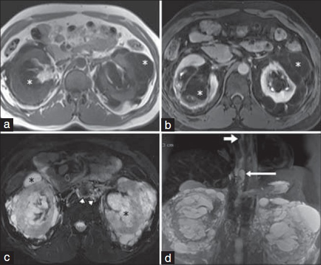 38-year-old male presented with bilateral flank pain and was later diagnosed with bilateral renal lymphangiectasia. (a) MRI axial T1-weighted image of the kidneys and (b) Axial post-contrast T1-weighted delayed phase image show the cysts have dark T1 signal (white asterisks) with lack of contrast pooling inside the cysts in the delayed phase, confirming absence of communication with the renal collecting system. (c) Axial T2 fat-suppressed weighted image and (d) coronal reformatted maximum intensity projection T2 fat-suppressed image demonstrate cysts with fluid signal intensity (black asterisks) and dilated retroperitoneal lymphatic channels (arrowheads), together with dilatation and tortuosity of the cisterna chyli (long arrow) and thoracic duct (short arrow).