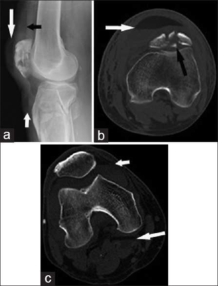 76-year-old man after a motor vehicular accident presents with extra-capsular fat–fluid levels. (a) Cross-table lateral radiograph shows fat–fluid levels in the prepatellar (long white arrow) and superficial infrapatellar bursae (short white arrow), along with lipohemarthrosis (black arrow) and acute comminuted patellar and tibia fractures. (b) Axial CT image shows the prepatellar bursa fat–fluid level (white arrow) and the adjacent acute comminuted patellar fracture (black arrow). 61-year-old man following acute intra-articular tibial fracture presents with an extra-capsular fat–fluid level (c) Axial CT image shows a fat–fluid level in a Baker cyst (long white arrow). Lipohemarthrosis is seen anteriorly (short white arrow).