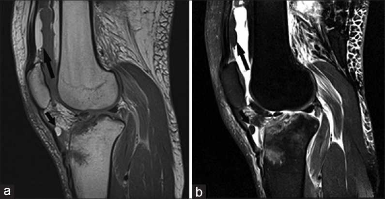 25-year-old man with an acute tibial fracture after a motor vehicle collision presents with extra-capsular floating fat. (a) Sagittal T1- and (b) sagittal T2-weighted fat-saturated images show a floating globule of fat (short arrows) in the deep infrapatellar bursa and lipohemarthrosis (long arrows).