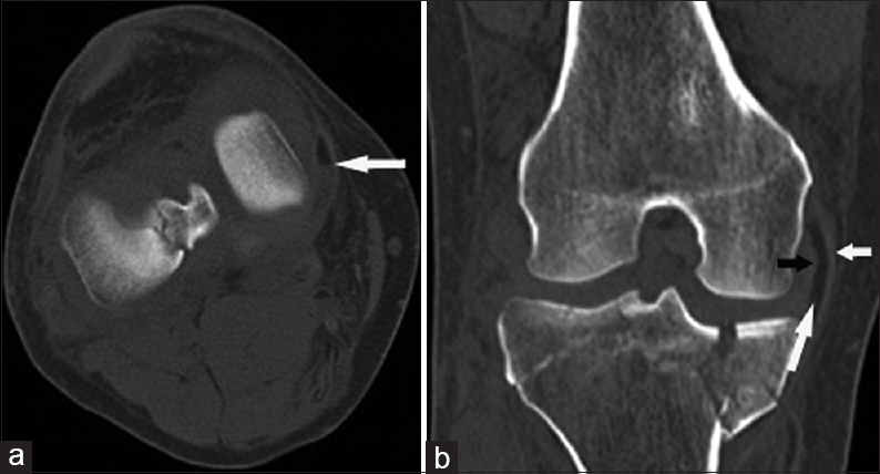 39-year-old man after a fall presents with a medial collateral ligament bursa fat–fluid level. (a) Axial CT image shows a fat–fluid level in the medical collateral ligament (MCL) bursa (arrow). (b) Coronal CT image shows the fat-containing MCL bursa (long white arrow) between the superficial (short white arrow) and deep (black arrow) layers of the MCL, and also an acute comminuted fracture involving the medial and lateral tibial plateau.