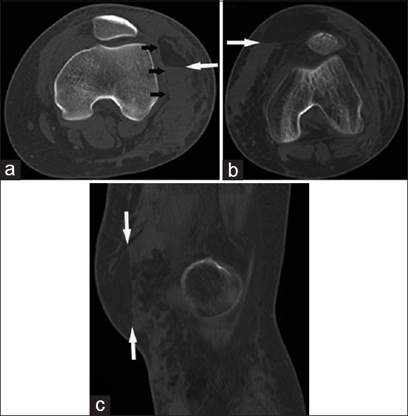 18-year-old-female pedestrian struck by an automobile presents with an extra-capsular fat–fluid levels in a non-anatomic soft-tissue space. (a) Axial CT image shows a fat–fluid level (long arrow) collecting in a Morel-Lavallée lesion, occurring in the subcutaneous fat along the margin of the crural fascia (short arrows). 77-year-old man following a motor vehicle accident presents with floating fat in an extra-capsular non-anatomic soft-tissue space. (b) Axial and (c) sagittal CT images show a distinct fat–fluid level centered in the subcutaneous fat (arrows). The post-traumatic fluid collection is not associated with the crural fascia, and does not conform to the location of an extra-capsular bursa.