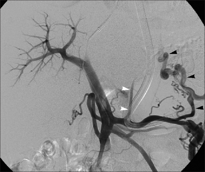Uncommon EV supply in 68-year-old man with grade 3 EVs. Splenoportal venogram performed during TIPS creation shows EV filling via large SGV (black arrowheads) and small LGV (white arrowheads).