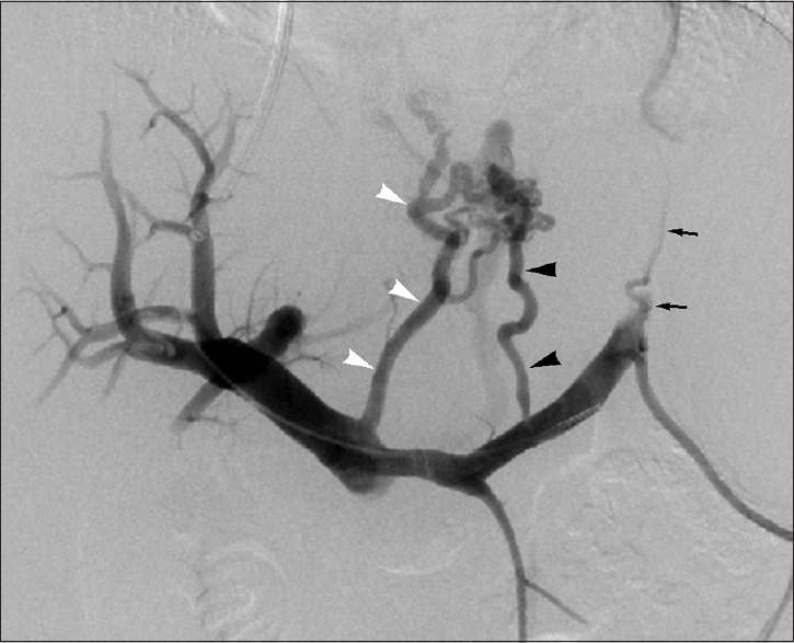 Standard IGV supply in 56-year-old woman with type 1 IGVs. Splenoportal venogram performed during TIPS creation displays IGV filling via LGV (white arrowheads), PGV (black arrowheads), and SGV (arrows).