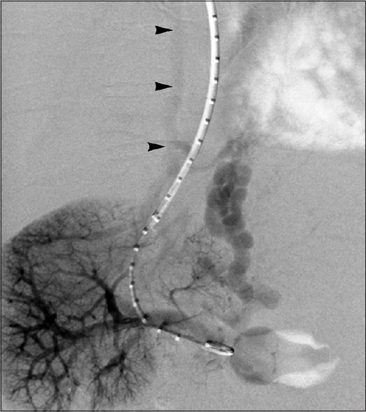 Conventional EV drainage in 59-year-old man with grade 3 EVs. Delayed portal venogram performed during TIPS creation demonstrates EV outflow via azygous venous system (arrowheads).