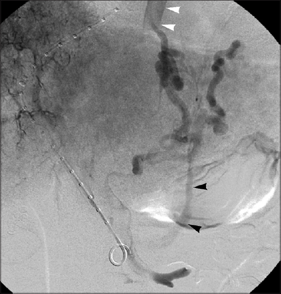 Mixed GEV drainage in 51-year-old man with type 1 GEVs. Delayed portal venogram performed during TIPS creation reveals GEV outflow via azygous venous system (white arrowheads) and left gastrorenal shunt (black arrowheads).