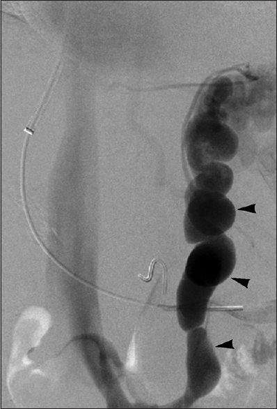 Archetypal IGV drainage in 53-year-old woman with type 1 IGVs. Delayed splenoportal venogram performed during TIPS creation shows IGV drainage via large left gastrorenal shunt (arrowheads).