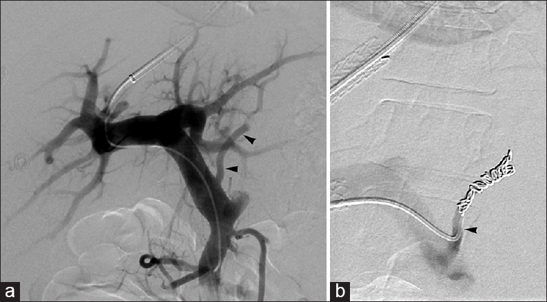 LGV embolization for treatment of grade 3 EVs in 35-year-old woman. Portal venogram (a) performed during TIPS creation displays EV supply via LGV (arrowheads). Left gastric venogram (b) performed after coil embolization shows complete occlusion of LGV (arrowhead).