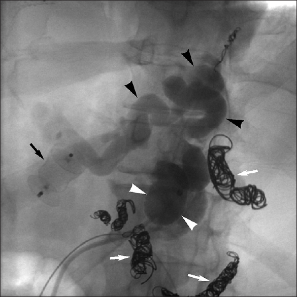 Balloon-occluded retrograde venogram performed during balloon-occluded retrograde obliteration of type 1 IGVs in 53-year-old man depicts occlusion balloon (white arrowheads) in left gastrorenal shunt and retrograde filling of gastric varices (black arrowheads). Note previously embolized LGV (black arrow), as well as PGVs and SGV (white arrows).