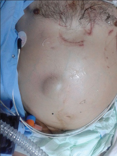 50-year-old male presented with edema of legs, erythema, pain, and abdominal swelling and was later diagnosed with chronic aortocaval fistula. Abdominal photograph of patient shows a continuous thrill (star), and a machine-like murmur was detected on the umbilical region of the abdomen.