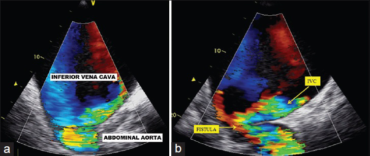 50-year-old male presented with edema of legs, erythema, pain, and abdominal swelling and was later diagnosed with chronic aortocaval fistula. Transesophageal echocardiography (a) on transverse plane, (b) on the region of abdominal murmur, show fistula between the abdominal aorta and the IVC.