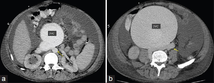 50-year-old male presented with edema of legs, erythema, pain, and abdominal swelling and was later diagnosed with chronic aortocaval fistula. Axial contrast-enhanced CT angiography, (120/350 cc contrast medium, injection rate 4 cc/sec, scan time 30. sec) shows fistula (black arrow) at the lower level of renal artery and the bifurcation of the aorta between the abdominal aorta (yellow arrow) and the IVC. (b) Axial contrast-enhanced CT angiography, showed fistula (black arrow) at the at the abdominal aortic bifurcation, between the abdominal aorta (yellow arrow) and the IVC.