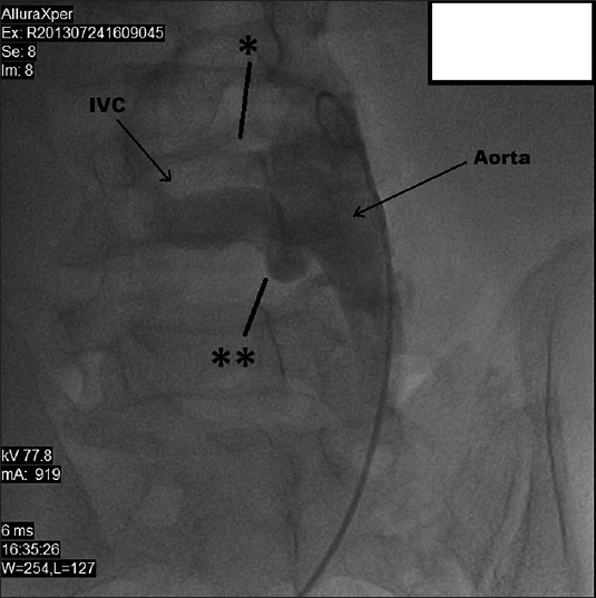 50-year-old male presented with edema of legs, erythema, pain, and abdominal swelling and was later diagnosed with chronic aortocaval fistula. Abdominal aortography shows two fistulas (stars) between the abdominal aorta and the IVC.