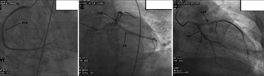 50-year-old male presented with edema of legs, erythema, pain, and abdominal swelling later diagnosed with chronic aortocaval fistula. Coronary arteries are seen on coronary angiography.