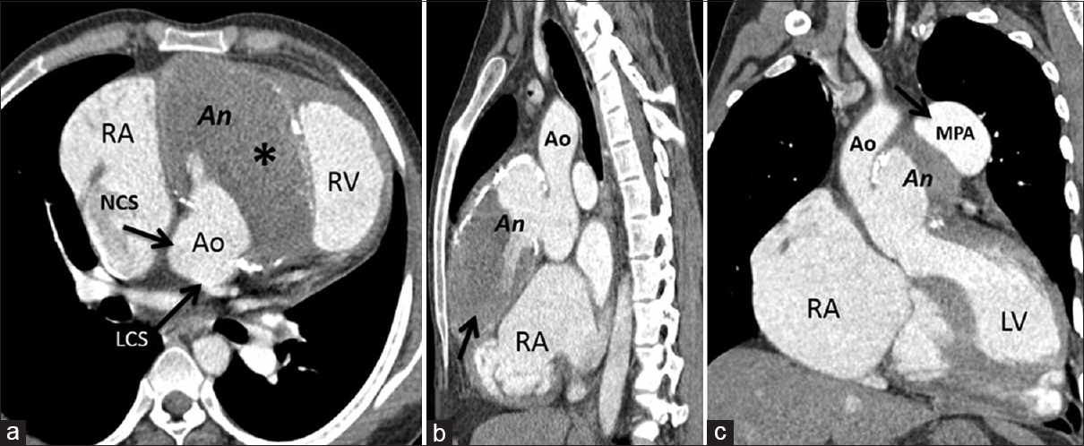 17-year-old boy with unruptured right sinus of Valsalva aneurysm, contrast-enhanced CT (a) Axial image reveals a large outpouching (An) arising from the right coronary sinus with eccentric thrombus (*) and peripheral thin calcification and normal LCS and NCS. (b) Oblique sagittal image shows partially thrombosed aneurysm (arrow) with normal aortic root (Ao). (c) Oblique coronal image shows aneurysm with dilated pulmonary artery (arrow) with normal ascending aorta and aortic annulus. Ao = Aortic root, LCS = Left coronary sinus, LV = Left ventricle, MPA = Main pulmonary artery, NCS = Non-coronary sinus, RA = Right atrium, RV = Right ventricle.