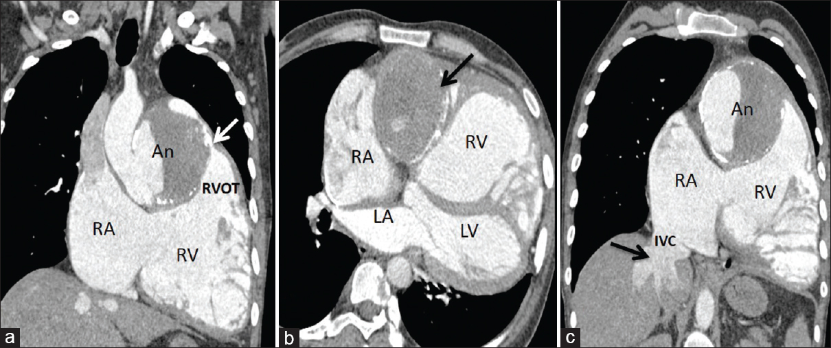 17-year-old boy with unruptured right sinus of Valsalva aneurysm, contrast-enhanced CT (a) Coronal image shows aneurysm (An) compressing the RVOT (arrow) with dilatation of RA and RV. (b) Axial image shows the aneurysm extending along right atrio-ventricular groove (arrow). (c) Oblique coronal image shows dilated right cardiac chambers, intrahepatic IVC, and hepatic veins (arrow). An = Aneurysm, LA = Left atrium, LV = Left ventricle, RA = Right atrium, RV = Right ventricle, RVOT = Right ventricular outflow tract, IVC = Inferior vena cava.