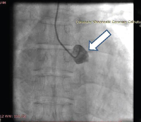 60-year-old male with ACS-inferior wall MI, post thrombolysis and post MI angina. Coronary angiography-AP view fluoroscopy shows blunt left sinus (arrow) with no coronary origin.