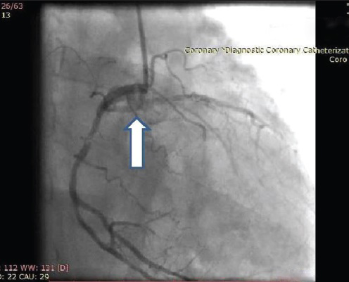 60-year-old male with ACS-inferior wall MI, post thrombolysis and post MI angina. Coronary angiography-right anterior oblique angiographic view shows both right and left coronaries originating from the right sinus (arrow).