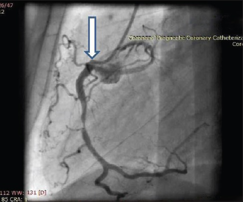 60-year-old male with ACS-inferior wall MI, post thrombolysis and post MI angina. Coronary angiography-lateral angiographic view shows both RCA and LCA originating from same ostium (arrow).