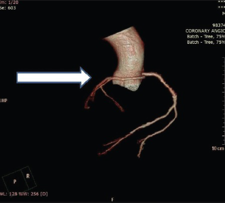 60-year-old male with ACS-inferior wall MI, post thrombolysis and post MI angina. CT coronary angiography-CT image with 3D reconstruction shows retroaortic course of LCA (arrow).