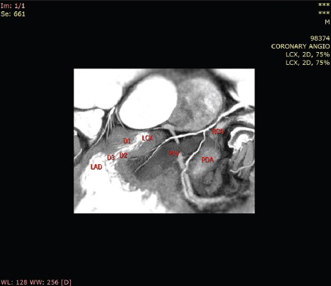 60-year-old male with ACS-inferior wall MI, post thrombolysis and post MI angina. CT coronary angiography-CT axial image shows all three coronary arteries.