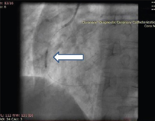 60-year-old male with ACS-inferior wall MI, post thrombolysis and post MI angina. Coronary angiography shows left anterior oblique fluoroscopic view of RCA during predilatation (arrow).