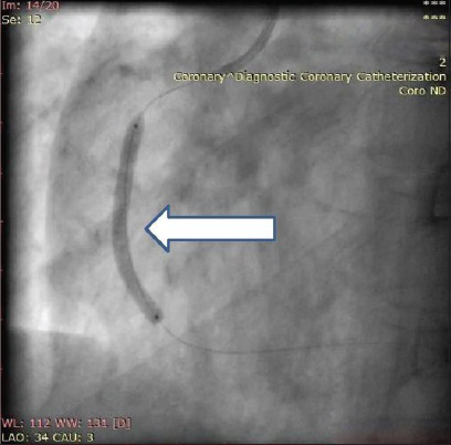 60-year-old male with ACS-inferior wall MI, post thrombolysis and post MI angina. Coronary angiograph shows left anterior oblique fluoroscopic view of RCA during stent deployment (arrow).