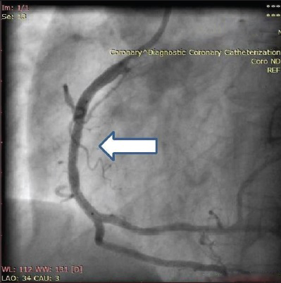 60-year-old male with ACS-inferior wall MI post thrombolysis and post MI angina. Coronary angiography-left anterior oblique angiographic view of RCA shows end result post stenting (arrow).