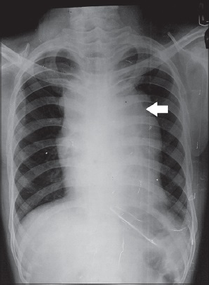 26-year-old male patient presented with fever, night sweat and shortness of breath, subsequently diagnosed to have pericardial effusion leading to cardiac tamponade. Further studies led to the diagnosis of Hodgkin lymphoma. Chest X-ray posteroanterior view shows mediastinal widening (arrow) suggestive of mediastinal lymphadenopathy.