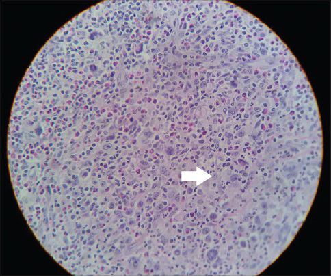 26-six-year-old male patient presented with fever, night sweat and shortness of breath, subsequently diagnosed to have pericardial effusion leading to cardiac tamponade. Further studies led to the diagnosis of Hodgkin lymphoma. Cervical lymph node biopsy stained with hematoxylin and eosin magnification ×10 shows lacunar variety of Reed Sternberg cell (arrow) suggestive of nodular sclerosing Hodgkin lymphoma.