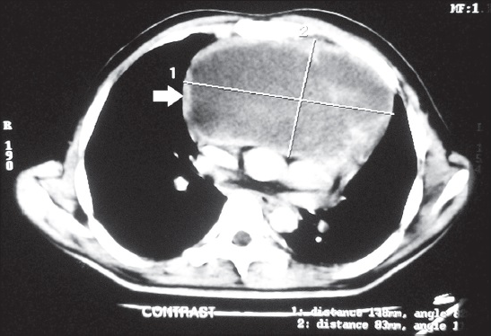 26-six-year-old male patient presented with fever, night sweat and shortness of breath, subsequently diagnosed to have pericardial effusion leading to cardiac tamponade. Further studies led to the diagnosis of Hodgkin lymphoma. Computed tomography scan thorax of the same patient shows anterior mediastinal lymphadenopathy (arrow) greatest dimension of the mass is 14.8 cm.