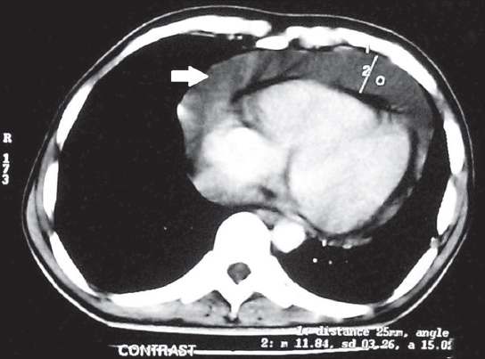 26-year-old male patient presented with fever, night sweat and shortness of breath, subsequently diagnosed to have pericardial effusion leading to cardiac tamponade. Further studies led to the diagnosis of Hodgkin lymphoma. Computed tomography scan thorax shows pericardial effusion (arrow).