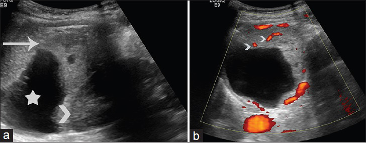 44-year-old woman with 4-month history of lumbar pain diagnosed with perivascular epithelioid cell tumor. (a) Sagittal sonographic image of the left hypochondrium depicts the presence of a large heterogenous left perirenal mass. The lesion has cystic parts (asterisk) and solid, heterogeneous components (long arrow). The mass is in close proximity to the ipsilateral kidney (arrowhead). (b) Sagittal power Doppler image of the left perirenal mass reveals vascularity of the solid parts (arrowheads).