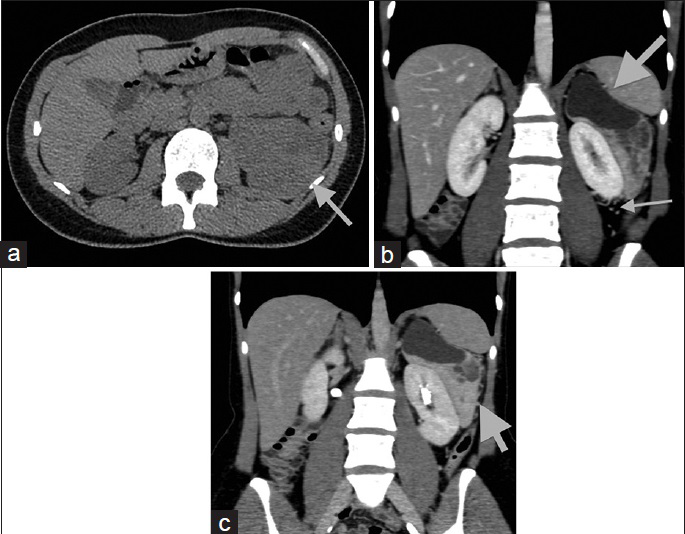 44-year-old woman with 4-month history of lumbar pain diagnosed with perivascular epithelioid cell tumor. (a) Transverse noncontrast computed tomography image demonstrates inhomogeneous solid parts of the lesion (arrow). The mean computed tomography density of the solid components is 35 HU on unenhanced images, similar to that of normal renal parenchyma. Coronal reformations during (b) the portal phase and (c) the excretory phase depict sharply demarcated left perinephric mass (arrow), partly cystic and solid, in close proximity to the renal capsule. The solid parts of the tumor enhance intensely and heterogeneously, with a mean portal phase attenuation of 100 HU. The left renal parenchyma is intact. Prominent vessels are seen in the left perirenal space adjacent to the lesion (long arrow).