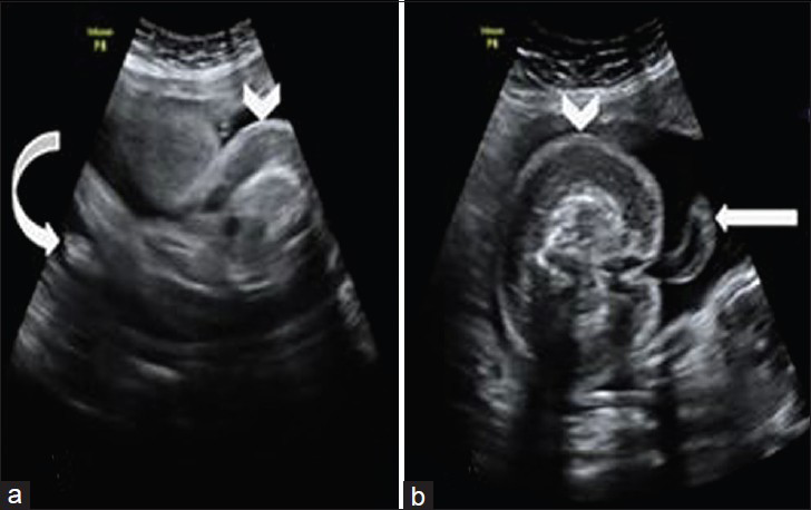22-year-old pregnant asymptomatic female who came for routine antenatal checkup, diagnosed with twin reversed arterial perfusion (TRAP) sequence pregnancy. Transabdominal ultrasonography scans (a) oblique and (b) axial views of abnormal fetus show well-developed lower limbs (curved arrow in a) with feet and umbilical cord (arrow in b), and diffuse, gross soft tissue edema (arrowheads).
