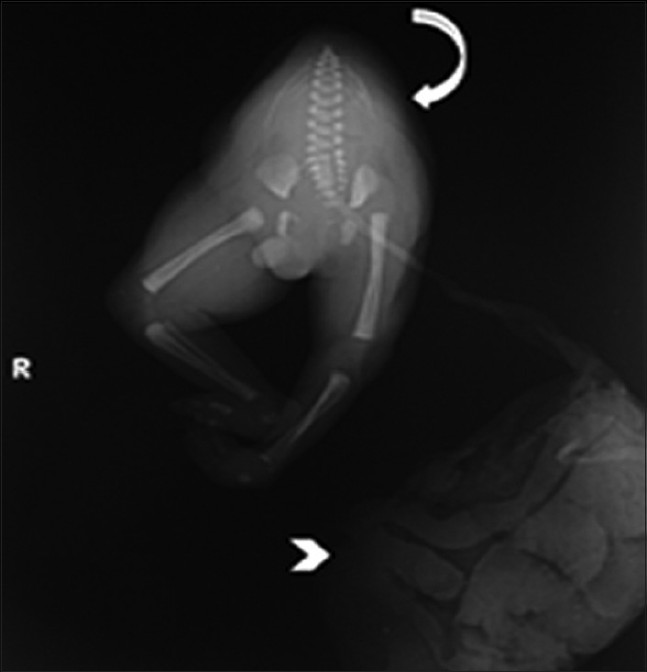 22-year-old pregnant asymptomatic female who came for routine antenatal checkup, diagnosed with twin reversed arterial perfusion (TRAP) sequence pregnancy. Postoperative day 1 plain X-ray (infantogram) of acardius acephalus twin shows normal lower limb bones, pelvic bone, lower vertebrae, last four paired ribs (curved arrow) with absence of cephalic structures (head, heart, upper limbs, and thorax), and a single placenta (arrowhead).