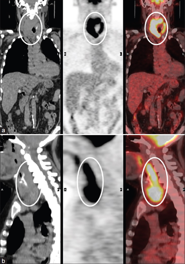 68-year-old female with newly diagnosed breast cancer found to have markedly enlarged fluorodeoxyglucose avid goiter with retropharyngeal extension. (a) Fluorine-18-fluorodeoxyglucose positron emission tomography/computed tomography coronal reformatted images of the neck and mediastinum including noncontrast computed tomography, fluorine-18-fluorodeoxyglucose positron emission tomography, and fused images demonstrate enlarged bilobar goiter with diffuse fluorodeoxyglucose avidity (white circles). (b) Fluorine-18-fluorodeoxyglucose positron emission tomography/computed tomography sagittal reformatted images of the neck including noncontrast computed tomography, fluorine-18-fluorodeoxyglucose positron emission tomography, and fused images demonstrate superior extension of the goiter into the retropharyngeal and prevertebral space (white circles).