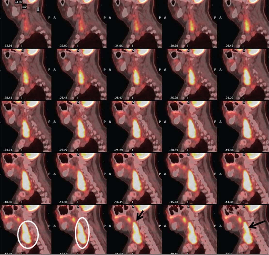 68-year-old female with newly diagnosed breast cancer found to have markedly enlarged fluorodeoxyglucose avid goiter with retropharyngeal extension. Serial fused computed tomography/fluorine-18-fluorodeoxyglucose positron emission tomography sagittal reformatted images of the neck from fluorine-18-fluorodeoxyglucose positron emission tomography/computed tomography scan demonstrate extent of retropharyngeal and prevertebral space involvement (white circles and black arrows).