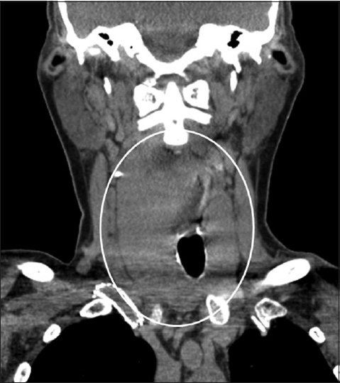 68-year-old female with newly diagnosed breast cancer found to have markedly enlarged bilobed goiter with retropharyngeal extension. Coronal noncontrast enhanced computed tomography with coned down view of the neck shows bilobar thyroid gland enlargement resulting in mild leftward tracheal deviation (white circle).