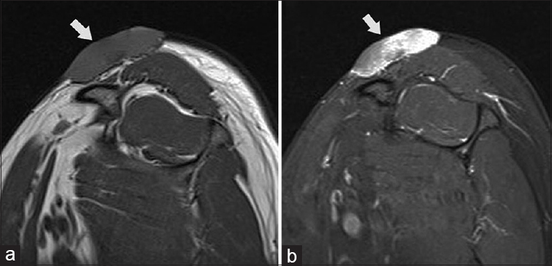 Dermatofibrosarcoma protuberans of the shoulder in a young female. Sagittal T1 (a) and PD FS (b) MR images of the shoulder showing the tumour (arrows) as well defined solid mass lying in the subcutaneous fat and in close relation to the skin; showing isointense signal on T1 and hyperintense signal on PD.