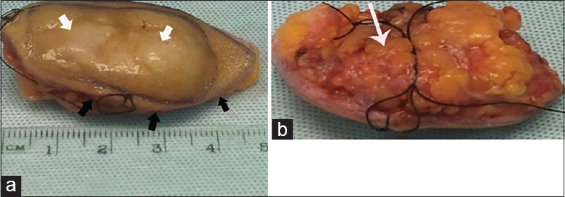 Macroscopic appearance of an excised dermatofibrosarcoma protuberans. (a) Gross examination shows oval-shaped mass with skin on one surface (black arrow) and fat on the opposite (white arrow). (b) Sectioning reveals the yellow-white solid nodular tumor (arrow).