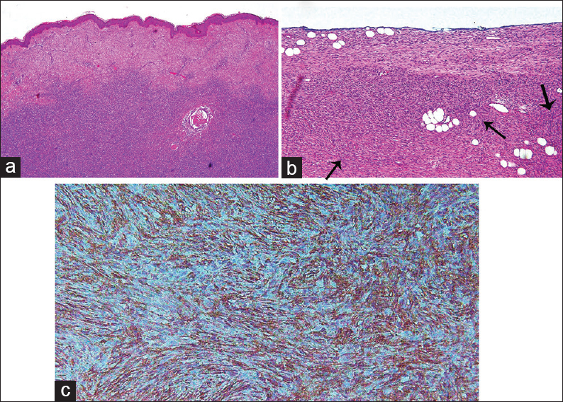 Typical histological findings of dermatofibrosarcoma protuberans. Hematoxylin- and eosin-stained tissue (a) low power microscope and (b) high power field show fibroblastic neoplasm with uniform appearance of storiform pattern (arrow) with minimal cellular pleomorphism and low mitotic activity. (c) Immunohistochemical staining for CD34 reveals positive result.