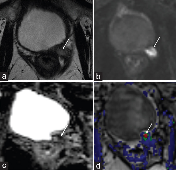 78-year-old male with a history of Gleason 7 prostate cancer status postradical prostatectomy in 1998 with localized recurrence in the left prostatectomy bed. (a) Axial T2-weighted, (b) diffusion weighted imaging, (c) apparent diffusion coefficient and (d) dynamic contrast enhanced images demonstrate a T2 intermediate signal nodule in the left prostatectomy bed with restricted diffusion and rapid contrast enhancement (arrows). The patient was advised to undergo pelvic irradiation but declined. He was briefly treated with androgen deprivation therapy, however subsequently declined further treatment