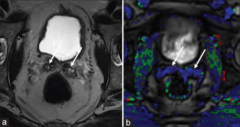 70-year-old male with a history of Gleason 6 prostate cancer status postprostatectomy 5 years previously with normal magnetic resonance appearance of retained seminal vesicles. (a) Axial T2-weighted and (b) dynamic contrast enhanced images through the prostatectomy bed show no residual prostate tissue status postprostatectomy. Normal T2 hyperintensity is maintained in retained seminal vesicles bilaterally, without rapid contrast enhancement to suggest recurrent tumor (arrows).