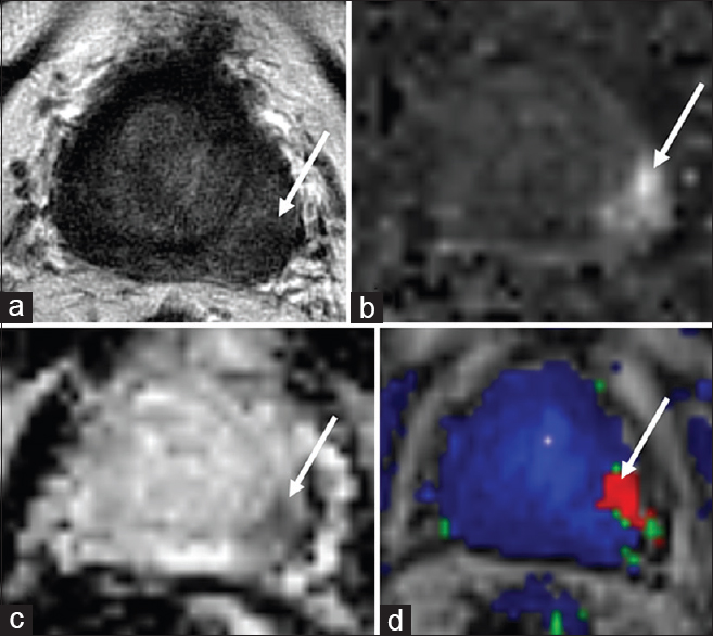 86-year-old male with a history of Gleason score 6 prostate cancer status postexternal beam radiation therapy in 2008 with localized recurrence in the left base peripheral zone. (a) Axial T2-weighted, (b) diffusion weighted imaging, (c) apparent diffusion coefficient and (d) dynamic contrast enhanced images demonstrate a focal T2 hypointense circumscribed nodule in the left base peripheral zone with restricted diffusion and rapid contrast enhancement (arrows). Biopsy confirmed high grade focally recurrent prostate cancer with perineural invasion. The patient was subsequently treated with high dose rate brachytherapy.