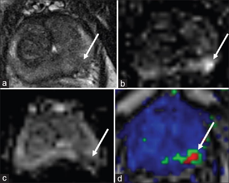 65-year-old male with a history of Gleason 6 prostate cancer status post with external beam radiation therapy 3 years previously with rising prostate-specific antigen and a suspicious lesion in the left mid-peripheral zone, biopsy pending. (a) Axial T2-weighted, (b) diffusion weighted imaging, (c) apparent diffusion coefficient, and (d) dynamic contrast enhanced images demonstrate an ill-defined T2 hypointense nodule in the left base peripheral zone with restricted diffusion and rapid contrast enhancement (arrows).