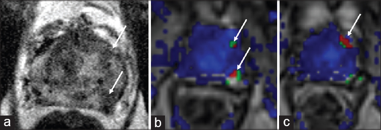 77-year-old male with a history of Gleason 6 prostate adenocarcinoma treated with low dose rate brachytherapy in 2005 with rising prostate-specific antigen and suspicious lesions in the left mid-peripheral zone. (a)_Axial T2-weighted and (b and c) dynamic contrast enhanced images demonstrate two circumscribed T2 hypointense nodules in the left mid peripheral zone with rapid contrast enhancement (arrows). Biopsy was not pursued as the patient did not desire salvage therapy and was deemed to be a poor candidate due to comorbidities.