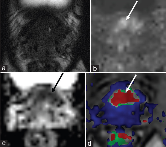 72-year-old male with a history of Gleason score 6 prostate cancer status post low dose rate brachytherapy in 2003 with rising prostate-specific antigen 11 years following treatment and findings consistent with recurrence in the anterior base transition zone. (a) Axial T2-weighted, (b) diffusion weighted imaging, (c) apparent diffusion coefficient, and (d) dynamic contrast enhanced images demonstrate a large area of restricted diffusion in the anterior base transition zone with associated rapid contrast enhancement (arrows). No discrete signal abnormality is seen in this region on T2-weighted images, but the zonal anatomy is obscured due to postradiation changes.