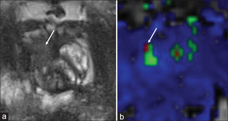 73-year-old male with a history of Gleason 7 prostate cancer treated with focal laser ablation therapy with rising prostate-specific antigen and findings suspicious for recurrence in the right anterior mid-peripheral zone. (a) Axial T2-weighted and (b) dynamic contrast enhanced images demonstrate a region of T2 hypointense signal in the right anterior mid-peripheral zone consistent with posttreatment changes (arrow), but within this region there is a small focus of rapid contrast wash-in and wash out (arrow), suspicious for recurrent tumor.